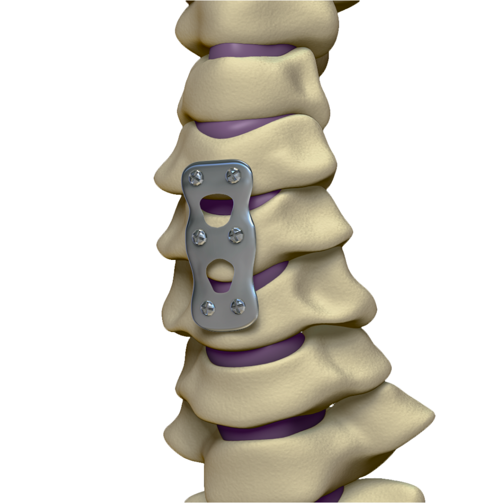 Clínica Atualli - Artrodese Cervical Clínica Atualli - Artrodese Cervical